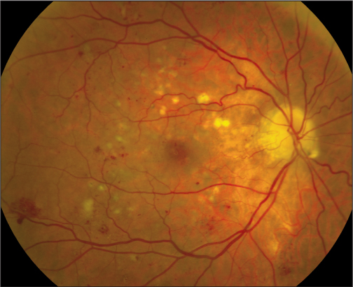 The Effect of GLP-1RAs in Diabetic Retinopathy