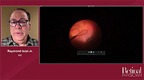 A Snare Technique for Removing an Intraocular Foreign Body