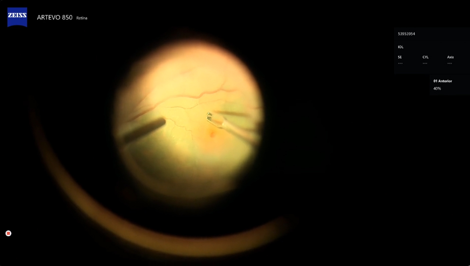 ILM Peel for Macular Hole