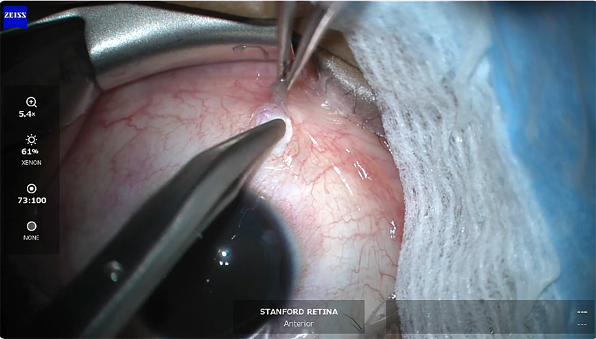 Sub-Tenon's Block for Vitreoretinal Surgery