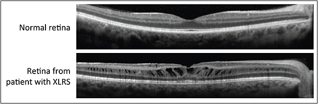 Retinal Physician PentaVision
