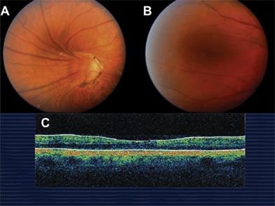 Vascular Ridge Rop Retinal Physician | PentaVision