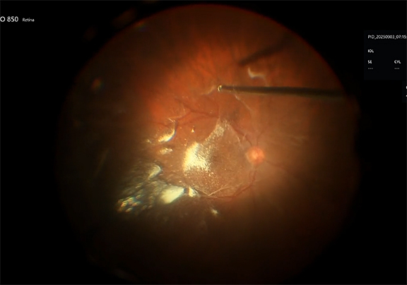 PVD Induction