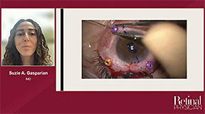 Management of Complex Dislocated In-the-Bag Intraocular Lenses