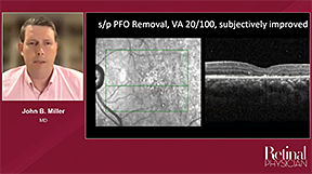 Technique for Removing Subretinal Perfluoro-Octane (PFO) Bubbles