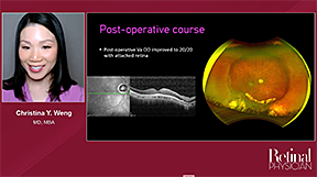 Managing Hemorrhage During Scleral Buckling