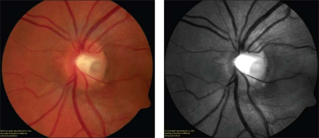 Retinal Physician | PentaVision